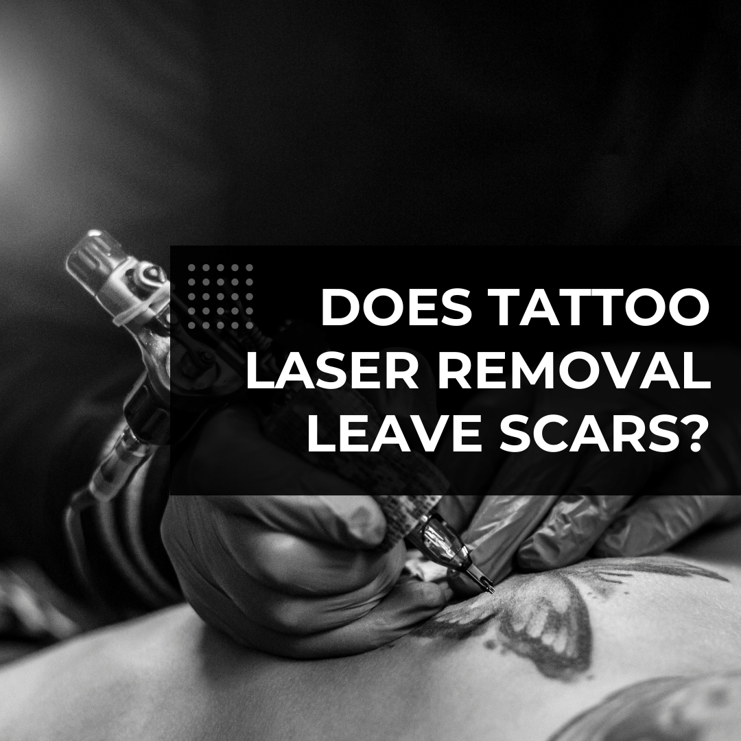Does Tattoo Laser Removal Leave Scars?